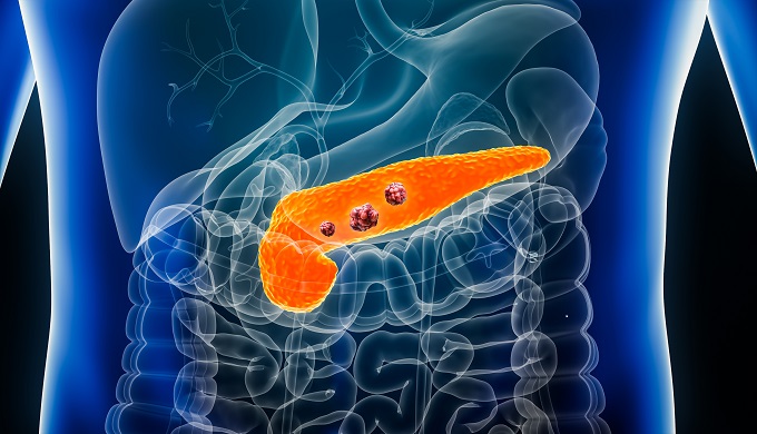 Pancreas or pancreatic cancer with organs and tumors or cancerous cells 3D rendering illustration with male body