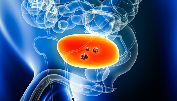 Urinary bladder cancer with organs and tumors or cancerous cells 3D rendering illustration with male body.