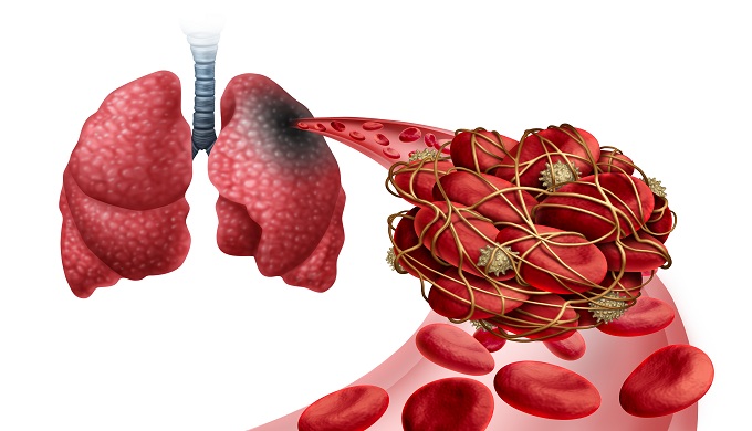 Pulmonary Embolism with a blood clot as a disease with a blockage of an artery in the lungs with 3D illustration elements.